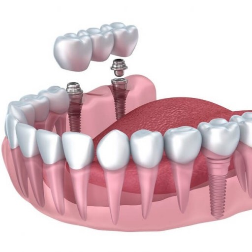 Zubní implantáty a sebevědomí